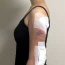 멍 | 간호사가 직접 받은 지방추출주사 1주일차(붓기, 멍 리얼 후기)