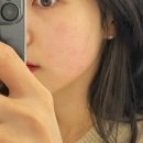 눈이랑안경 | 부산 경성대피부과 인모드FX 3회차 내돈내산 (전/후) | 당일 붓기, 멍, 붉어짐 후기