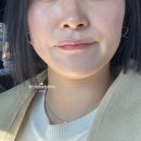 울트라짐 | 울트라클리어 레이저 후기 기미 흉터 모공 좋아졌어요