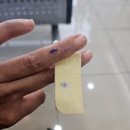 새손병원 | 새손병원 핀제거 수술 후기(입원기간, 마취 부작용)