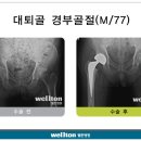 [인공고관절수술] 고관절 골절, 초기에 관리 필요 이미지