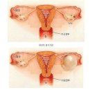 난소낭종 - 증상 &amp; 분류 &amp; 주기 이미지