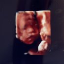 사하구-24 | 사하구 에디스여성병원 24주차 임당검사후기