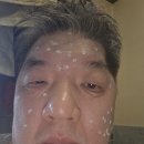 비립종 이미지