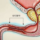 한 평생을 괴롭히는 요도 협착 이미지