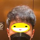 9 | 터키모발이식받은지 9년되었습니다(후기)