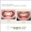 서울정성가득치과의원 | 연세라벤더 교정치과 "4월 청소년, 성인 치아교정" 후기