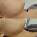 힐메디 | 성성동 피부관리 다시 찾아간 디어힐메디스킨 내돈내산 후기