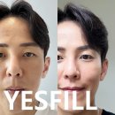 예스병원 | 압구정 피부과 각질제거 6세대필링 예스필 가격, 효과 정리 ZIP!