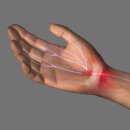 원당으뜸신경외과의원 | 손목 터널은 괜찮은데 손등 감각이 무디다면? 요골신경 분지의 미세 압박 점검