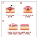 신신화학 | 아기 모기 알레르기 심할 때! 여름 필수 모기대비템 추천, 모기 물렸을 때 붓기 / 열감 관리 육아템