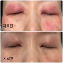 이지에프올로지의원 | 성인아토피 극복기 (붉은얼굴,홍조)