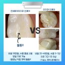 화이트디지털치과기공소 네이버블로그
