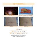 단일담석수술후기. 몇 년 간의 복통으로 소화의 문제인지 위내시경만 하다가 건강검진 복부 초음파로 담석이 있음을... 이미지