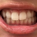 와이치과의원 | [내돈내산] 수원 치아미백 후기 치과 추천 &#39;라운드치과병원&#39;