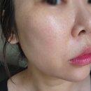 멍타임 | 서현역피부과 물광주사 엘라비에밸런스 리투오 후기 (+통증, 멍, 다운타임, 효과)