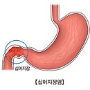 십이지장 궤양 (Duodenal Ulcer) 이미지