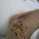개강과 함께하는 발목 인대 완전 파열! 와우! - 3월 일상과 깁스한달체험기