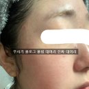 믿음삼대한의원 | 주사피부염 피부과 안 맞았던 이유 말합니다