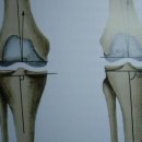무릎 퇴행성관절염증상과 특징 이미지