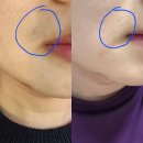 청주남자수염제모 &#39;젠틀맥스프로플러스&#39; 수염 레이저 제모 효과 3회차 후기