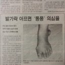 통풍 발목혹,알즈너가 해결한다 이미지