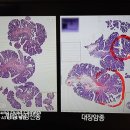 갑상선 결절/대장 용종 제거의 효과 이미지