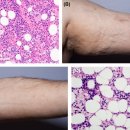 재생불량성 빈혈[aplastic anemia] 이미지