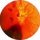 초자체 출혈[vitreous hemorrhage] 이미지