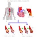 두 번째 급성심근경색증[최초로 발생한 급성심근경색증의 진단확정일부터 그 날을 포함하여 1년(갱신계약을 포함합니다)이 지난 날의 다음날] 이미지