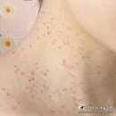 성지외과의원 | 수원 편평사마귀 성지 미드림성형외과에서 시술부터 경과까지
