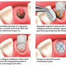 일산스타28치과의원 | 이 뺀 자리에 골이식을 꼭 해야 하나요?