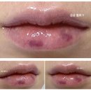 멍머리 | 입술 필러 후기 전후차이 비교 내돈내산 부작용, 붓기, 멍 상태