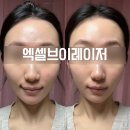 강남 엑셀브이레이저 후기 시술주기 브이빔레이저 제네시스토닝 차이