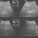 LC &amp; ascites &amp; pancreatitis 이미지