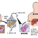 췌도 이식[islet transplantation] 이미지