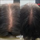 외도동 주민센터 | 제주시 외도주민센타부근 두피생장술시술 효과 다른 두피관리와 다른점은 뭘까?