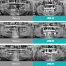희망찬치과의원 | 다산동치과 87세 잇몸 무너진 전악 임플란트 식립한 전문의 전략