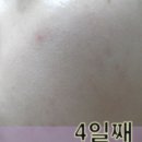 예그린약국 | 추천] 봉독화장품 동성제약 에이씨케어 워터 에센스 사용후기 - 걱정되는 내 피부 take care a.c.care