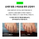 닥터디자이너의원 | 내향성 발톱 완전 가이드 | 닥터디자이너의원 송도점 문제성발톱 클리닉센터