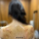 수성탑 한의원 | 경산 피부 관리샵 내돈내산 새빛 스킨 앤 바디에서 대구 어혈 멍 빼기