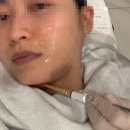 바로일성형외과의원 | 신논현 강남 성형외과 온다리프팅 튠페이스 한달 리얼 후기