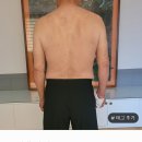 70대 남성분의 기치료 한달전후의 뒷면 비교사진 이미지