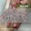 16개월 아기 수족구 리얼후기 2편｜수포 폭발… 가장 힘들었던 4~6일차 기록