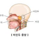 비인두암 과 원인 그리고 이미지