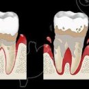 잇몸 염증 치은염 원인 증상 치주염 진단 치료 치주질환 이미지