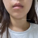 천인한의원 | 부천 신중동 피부과 얼굴 살 없는 사람의 풀페이스 인모드 후기