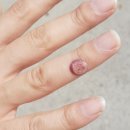 미소핀피부과 | 미소핀피부과 사마귀제거 후기! 테크노폴리스피부과 현풍피부과
