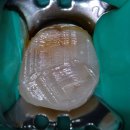 엔도코어 이미지