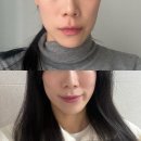 청담가구갤러리 | [청담피부과] 결혼식 한달 전 받은 웨딩관리 - 내돈내산 티타늄리프팅 효과, 후기, 가격 공유